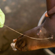 A Guinea worm being extracted from a child’s foot at a containment center in Savelugu, Ghana in a March 2007 photo. The worm found in the Vietnam case was a related species, possibly native to reptiles.